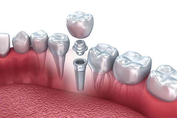 dental-implants
